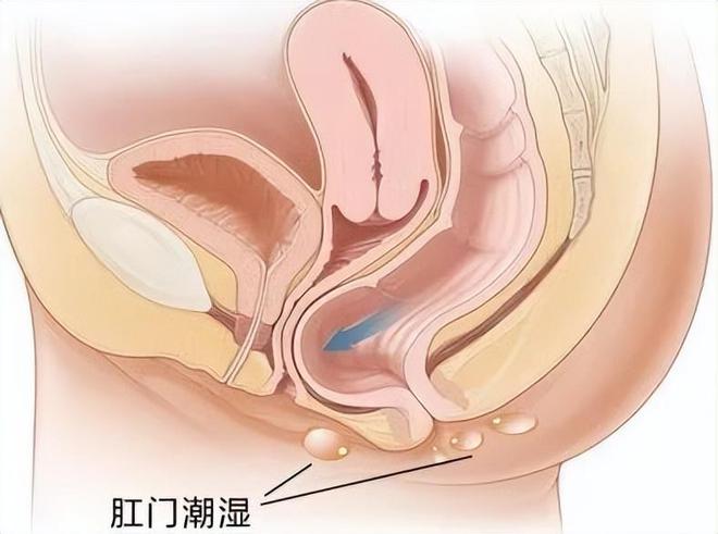 肛门潮湿是怎么回事是病吗？9博体育(图3)